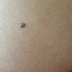 Seborrheic Wart