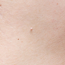 Skin Tag