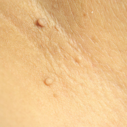 Skin Tag