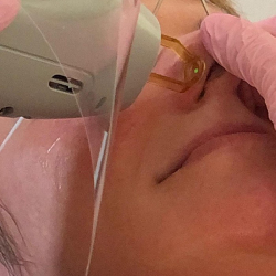 Thread Vein Removal on Nose