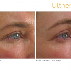 Ultherapy before and after