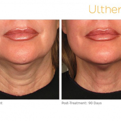 Ultherapy before and after