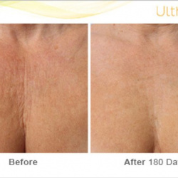 Ultherapy before and after