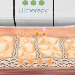 Ultherapy