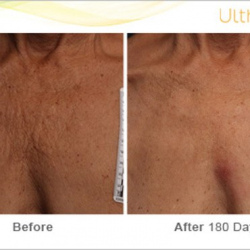 Ultherapy before and after