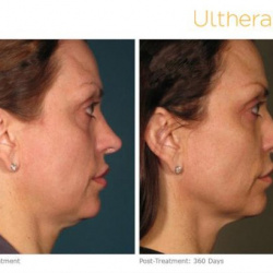 Ultherapy before and after