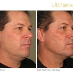Ultherapy before and after